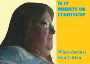 Is It Obesity Or Cushing's